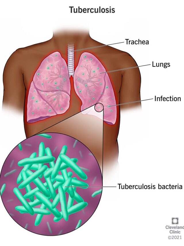 Pulmonary Tuberculosis