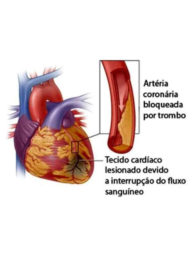 Cardiovascular Disease in Men